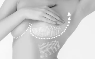 Prendre soin des cicatrices du lifting mammaire pour mieux les atténuer