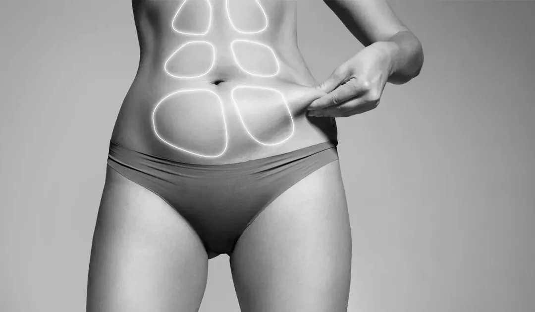 5 Zones que la liposuccion peut réellement sublimer
